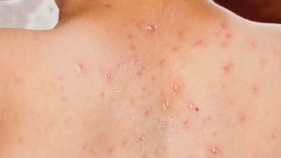 在苏邦发现数百例麻疹病例