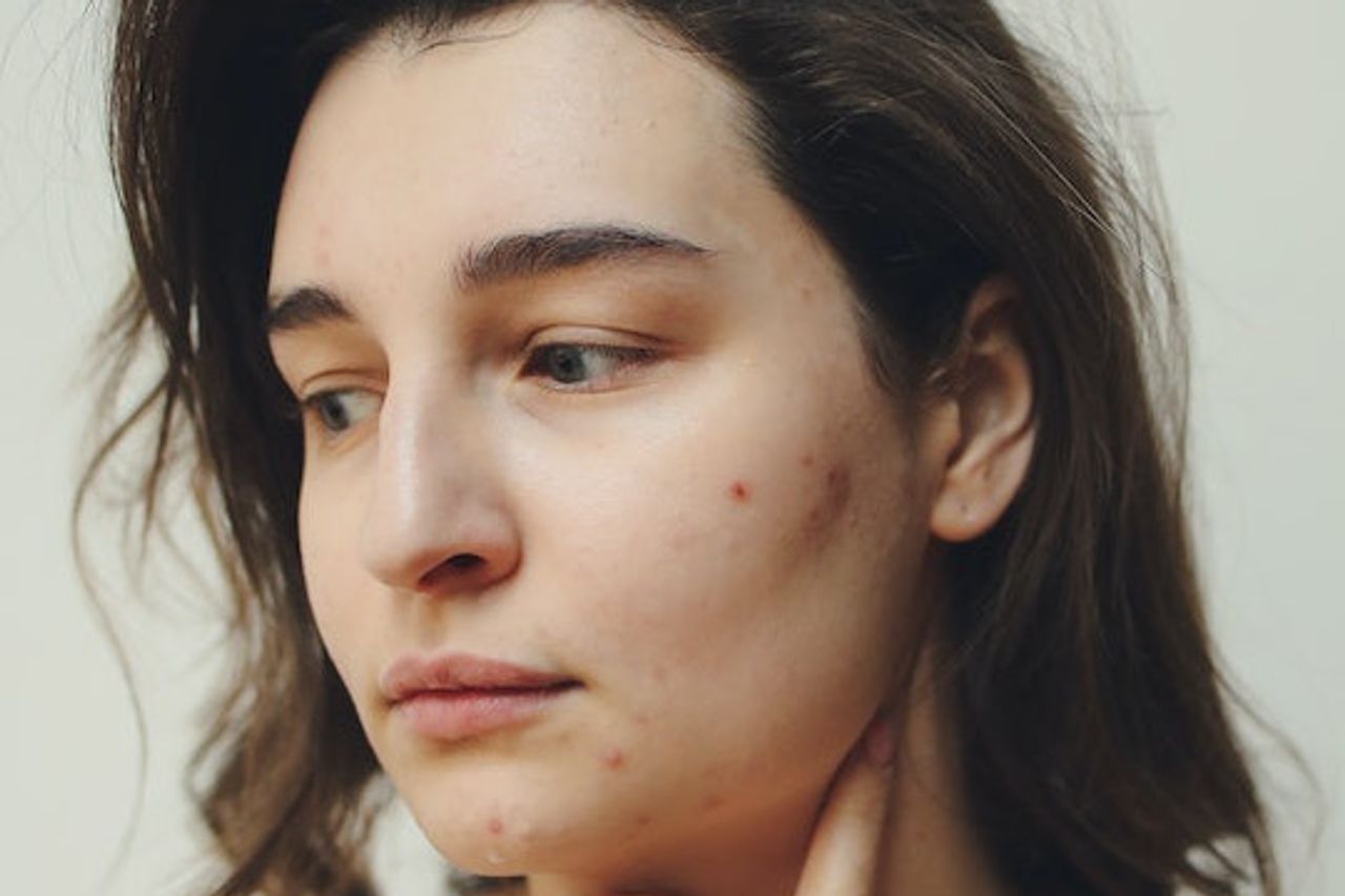 医学的に治療する必要があるにきびの症状、兆候は何ですか?