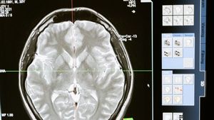 Tips Agar Terhindar dari Stroke dan Pendarahan di Otak seperti Tukul Arwana