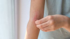 Mengenal Kandungan Bahan Skincare yang Baik dan Buruk untuk Kulit Eksim