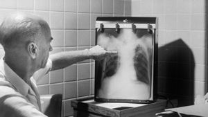 Apa Saja Ciri Penyakit TBC yang Sudah Parah? Ini Jawabannya