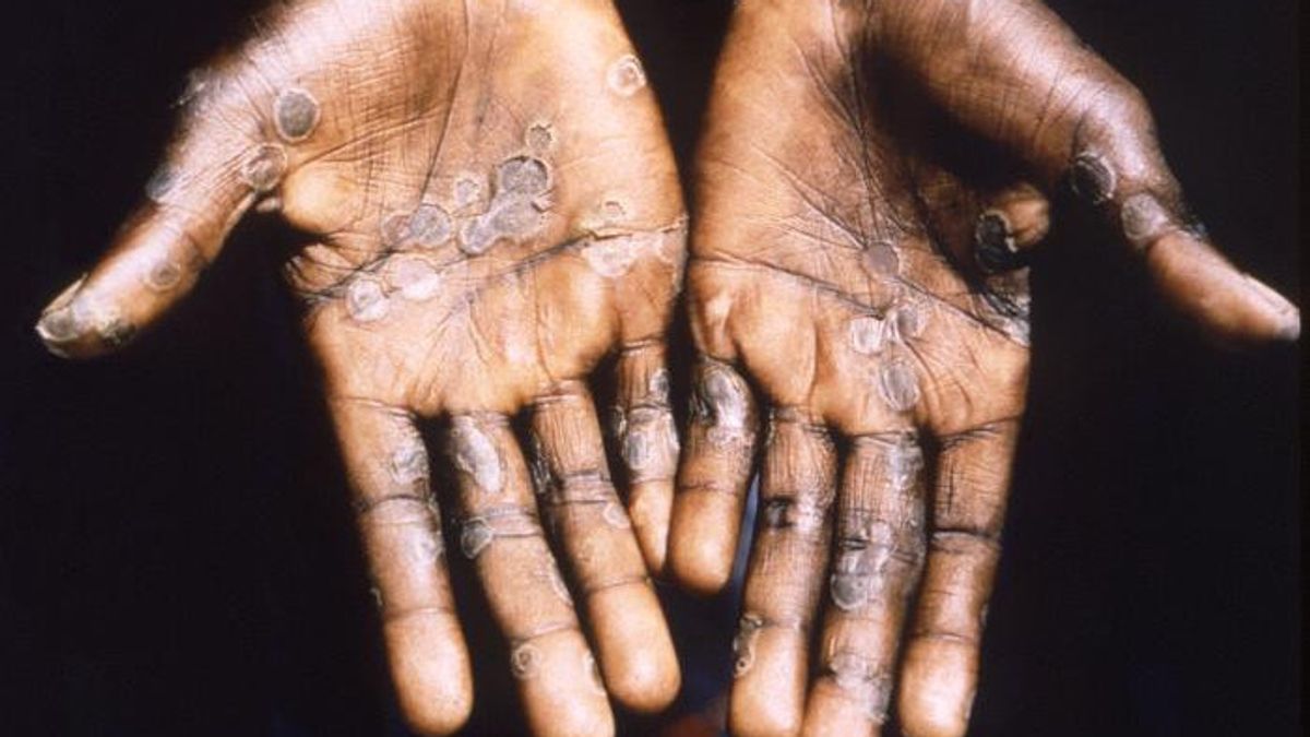 Los Angeles Reports First Death Related to Monkeypox, Victims Experience Severe Immune Disorders