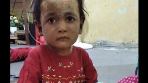 Viral Anak Berpenyakit Kulit Langka di Medan, Mirip Haykal dan Zakira