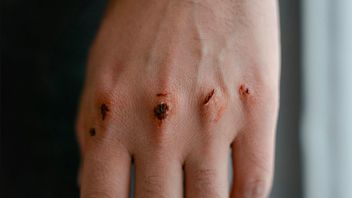 ne vous trompez plus, c'est la bonne étape pour gérer les petites blessures
