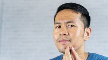 7 Cara Mengurangi Keringat Berlebihan di Wajah, Apa Sih Penyebabnya?