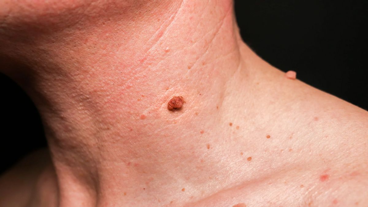 Acétate de salicylique pour les verrues: types et mode d'emploi