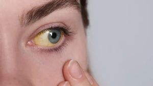 Cara Memutihkan Mata Kuning: Penyebab, Pengobatan, dan Kapan Harus ke Dokter