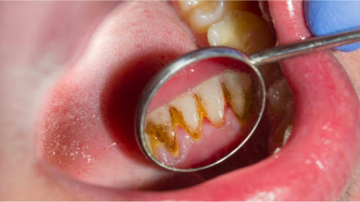 Faktor Penyebab Timbulnya Karang Gigi yang Paling Umum