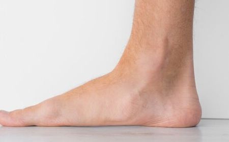 Telapak Kaki Datar atau Flat Foot, Kenali Efek dan Penyebabnya