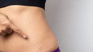 <i>Stretch Mark</i> pada Remaja: Penyebab dan Cara Mencegahnya 