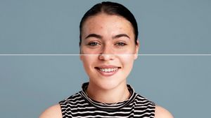 7 Kandungan Skincare untuk Menghilangkan Bekas Jerawat, Ampuh Bikin Kulit Cerah Lagi