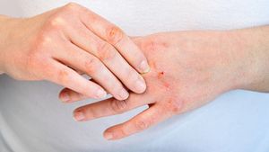 Mengenal Dermatitis Kontak Akibat Alergi Deterjen, Berikut Gejala dan Cara Mengobatinya