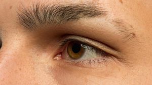 Causes Of The Eyes Of Adults And Children Of Yellow Color