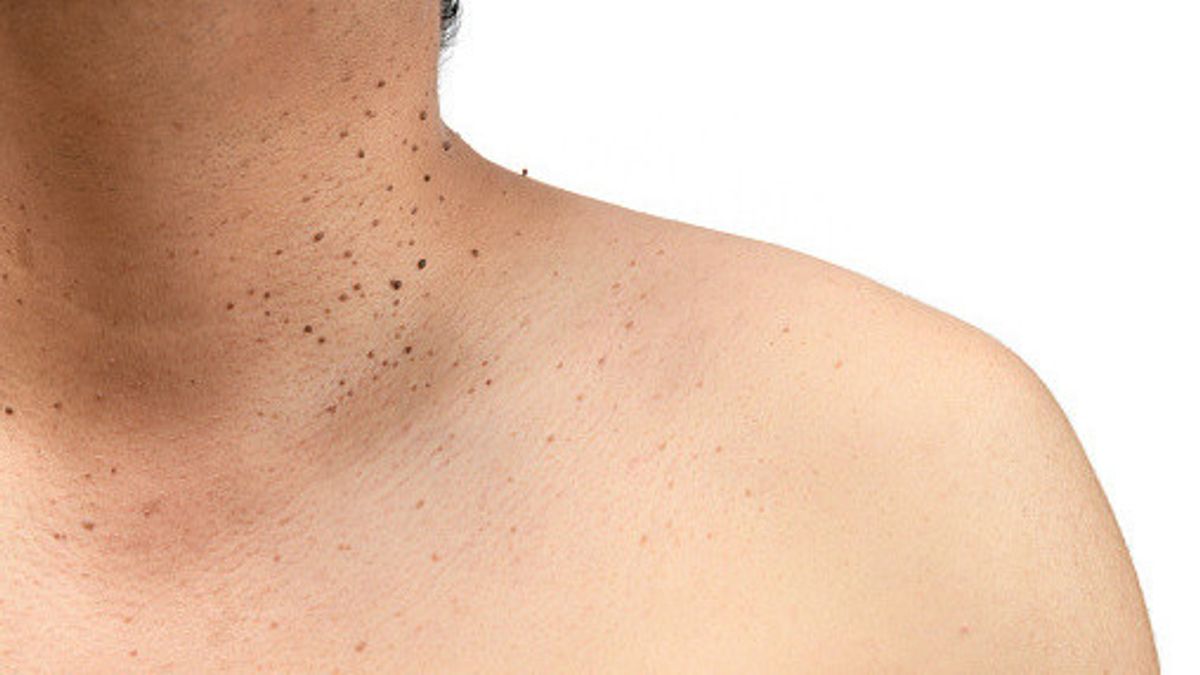 5 حقائق حول علامات الجلد ، ومعرفة الأسباب وكيفية الوقاية منها