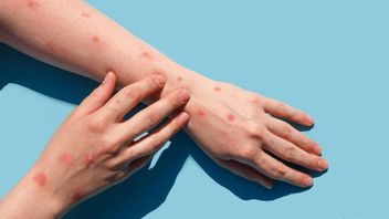 Un nouveau souche de Mpox, combinant deux types de virus, a été identifiée en Angleterre