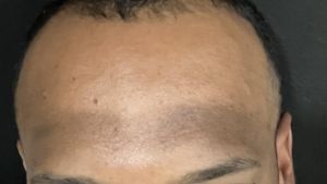 Causes of the Forehead Skin Being Darker than the Face and How to Overcome It