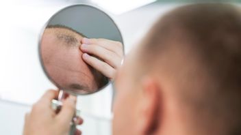 Get To Know The Pattern Of Hair Clashes Due To Hormones: What Is Appecia Androgenetik?