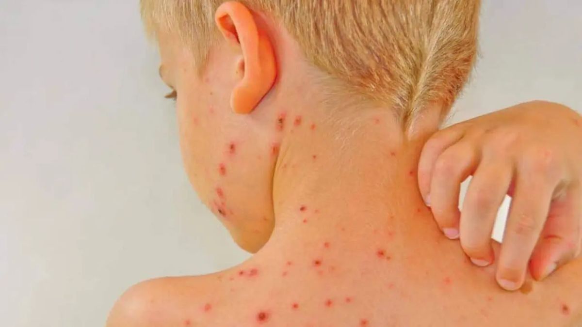 儿童麻疹：原因，症状以及如何治疗 