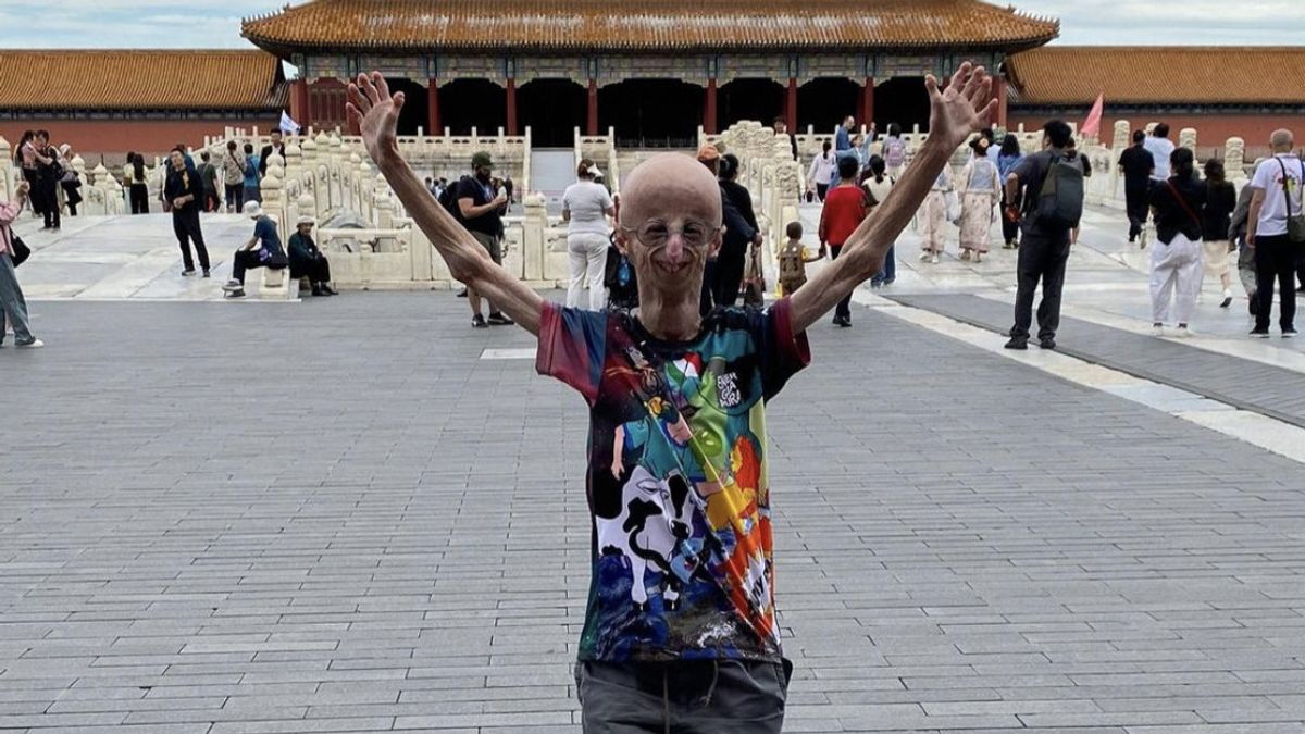 Experienced A Rare Disease, Sammy Basso Becomes The Longest Progerian Patient To Die