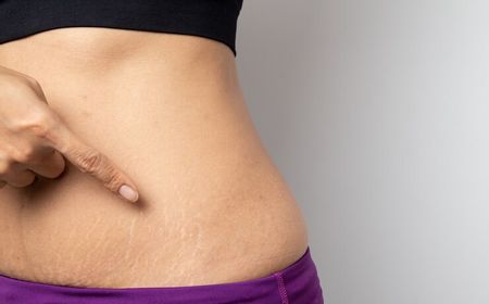 Stretch Mark pada Remaja: Penyebab dan Cara Mencegahnya