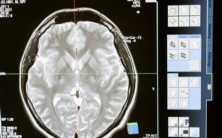 Belajar dari Peristiwa Tukul Arwana, Begini Cara Hindari Pendarahan di Otak