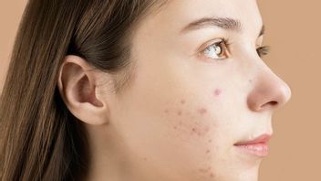 Getting To Know Fungal Acne, Acne That Is Related To Muncul