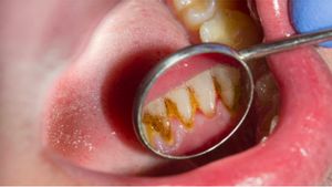 Faktor Penyebab Timbulnya Karang Gigi yang Paling Umum