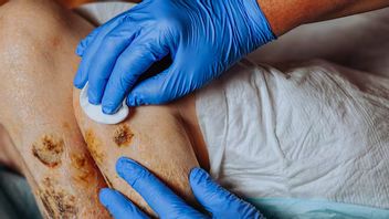 cottes sur les blessures peuvent nuire à la peau