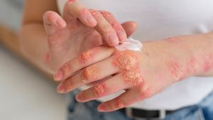 Waspadai Post Herpetic Neuralgia, Kenali Gejala dan Cara Mengatasinya