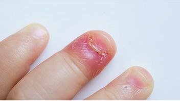 頻繁に手術を受ける、爪のカンタン治療のための5つの自然なテクニック