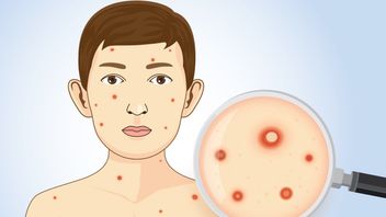 如何防止水痘繁殖而不传播