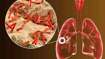 How To Transmission Tuberculosis, How To Prevent, To Symptoms