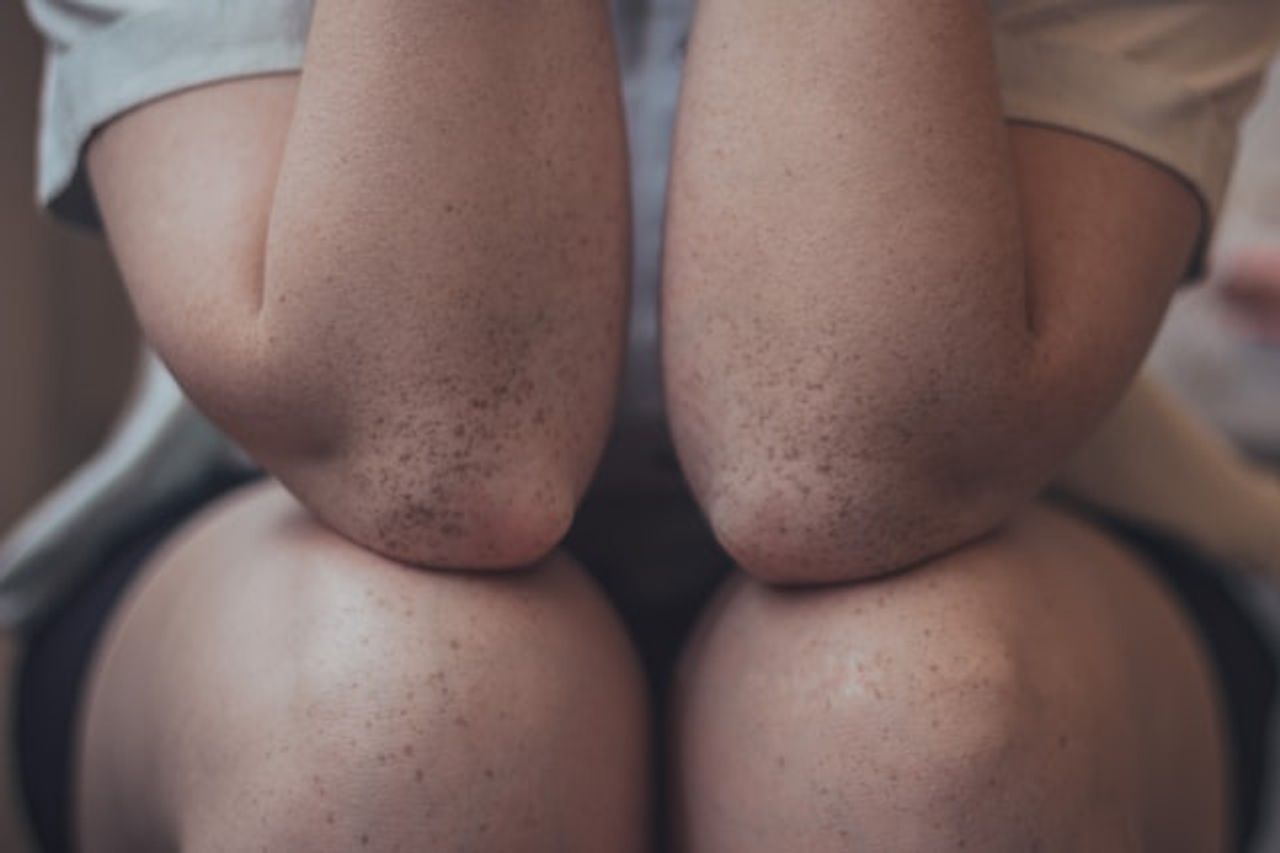 Having Dry Elbow Skin? Try These 7 Tips to Overcome It to Get Moisturized