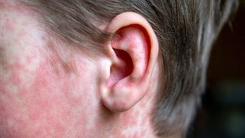 항생제가 홍역을 치료할 수 있습니까? 이것이 설명입니다.