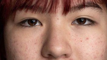 Bruntusan face? Watch how to remove sand acne quickly in 1 day before it's too late