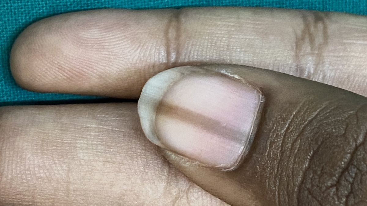 Don't Be As Simple As Black-lined Nails, Because They Can Be Without Serious Diseases