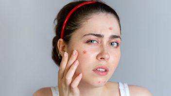 Kiat Sederhana Mengatasi Jerawat Hormonal, Mulai dari Rutin Merawat Hingga Jaga Pola Makan