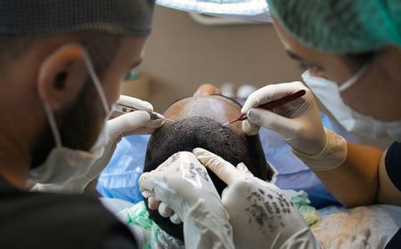 Apa Efek dari Transplantasi Rambut? Simak Dampak Negatifnya di Sini