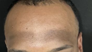 Causes of the Forehead Skin Being Darker than the Face and How to Overcome It