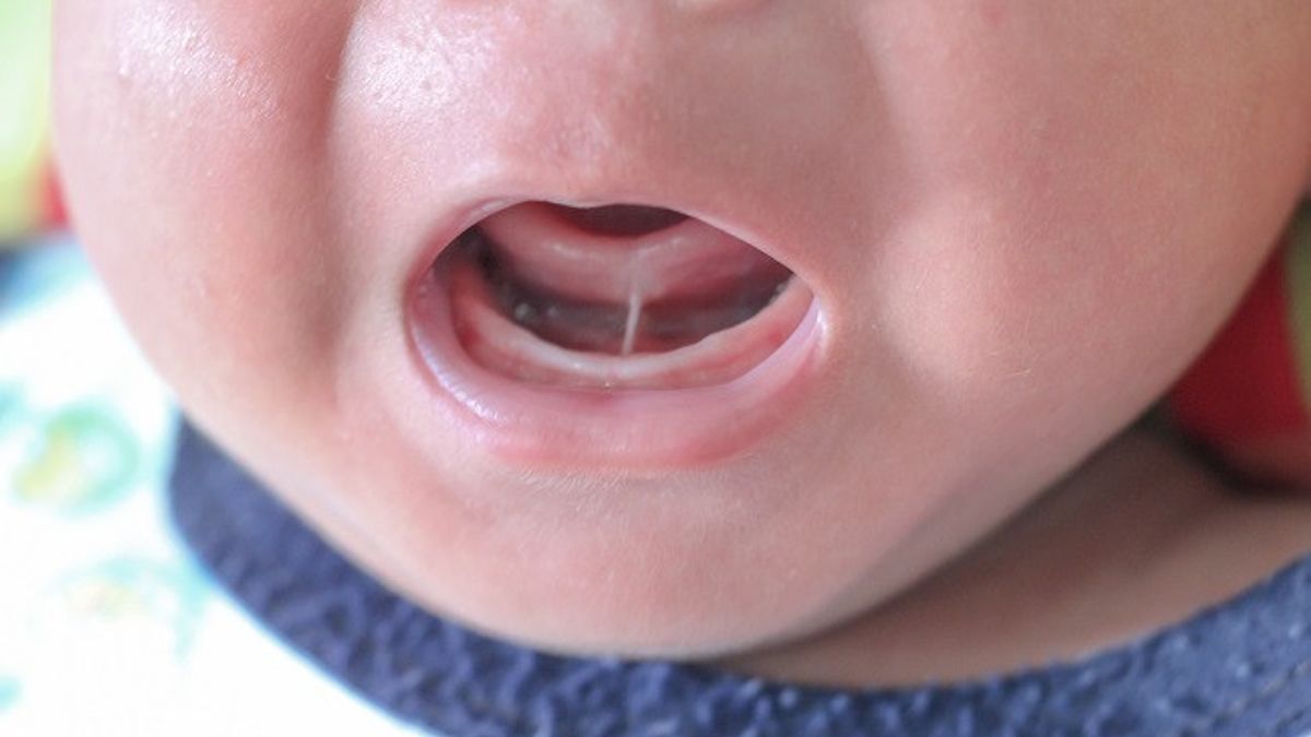 Tounge-tie Sebabkan Keterlambatan Bicara, Mitos atau Fakta?