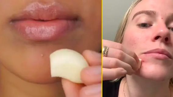 Is It True That Garlic Is Effectively Used To Overcome Acne?