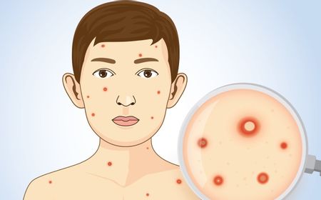 Cara Mencegah Cacar Air Agar Tidak Bertambah Banyak dan Tidak Menular