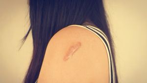 6 Ciri-ciri Keloid Berbahaya: dari Warna hingga Rasanya
