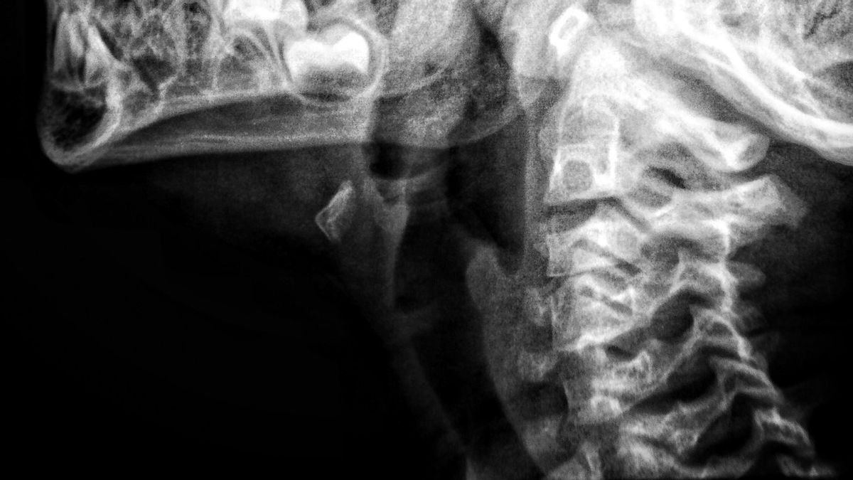 Trapped In Fiber Optical Cable In The Neck, Students In South Jakarta Experienced Can't Talk For 7 Months