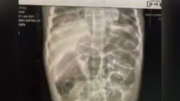 Balita di Sukabumi Meninggal Dipenuhi Cacing, KPAI Desak RUU Pengasuhan Anak Disahkan