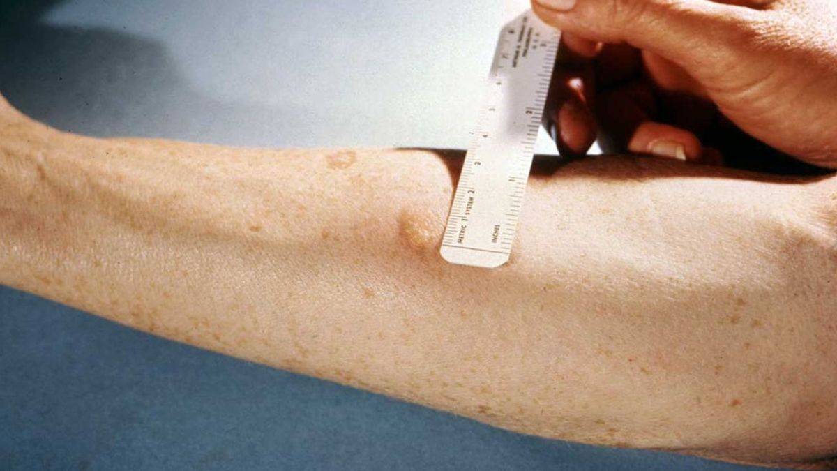 Waspada TBC! Ketahui Apa Itu Tes Mantoux sebagai Diagnosis Awal 