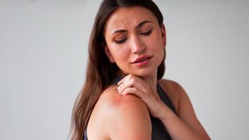 Dampak Paparan Sinar Matahari Berlebih Bisa Picu Fotodermatitis