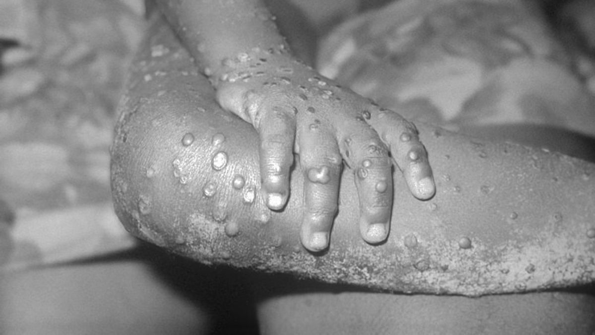 Monkeypox Jadi Kedaruratan Kesehatan Global, Distan Mataram Perketat Lalu Lintas Hewan