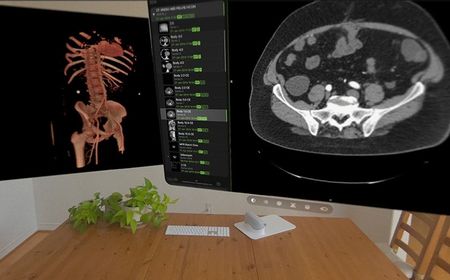 Apple Vision Pro Dukung Transformasi Kesehatan di Bidang Radiologi