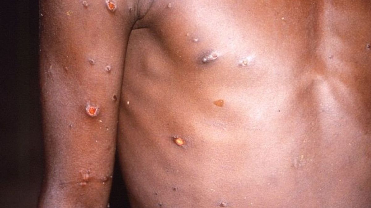 謎の肝炎が終わっておらず、アメリカで確認されたモンキーポックスが登場